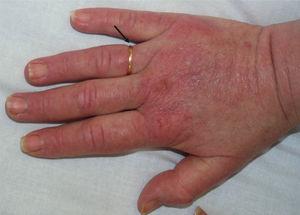 Erythematous macular lesions on the metacarpophalangeal joints and the dorsum of the fingers, with edema (the arrow indicates the pressure exerted by the patient's ring).