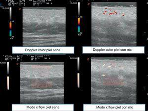 Ultrasound images comparing color Doppler in healthy skin and skin with capillary malformations and X flow in healthy skin and skin with capillary malformations. CM indicates capillary malformations.