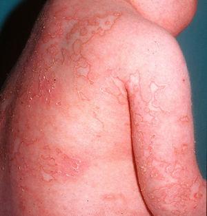 DITRA (deficiency of the IL-36 receptor antagonist). Generalized pustular eruption with polycyclic contours on an erythematous base, similar to an outbreak of generalized pustular psoriasis.