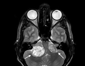 Vestibular schwannomas (indicated by arrows) in the magnetic resonance imaging of a patient with neurofibromatosis type 2.
