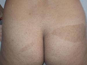 Café-au-Lait spots on the buttocks of a patient with neurofibromatosis type 2. The color is lighter than in the spots typically observed in neurofibromatosis type 1.