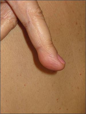 Plaque-type neural proliferation on the pulp of finger of a patient with neurofibromatosis type 2.