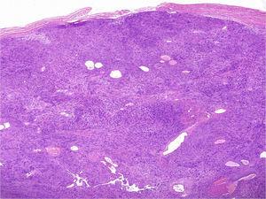 Neural proliferation with classic schwannoma pattern. A spindle-cell proliferation is observed, located in the dermis. The lesion is compact and encapsulated, with Antoni A areas rich in cells in which Verocay bodies can be seen. Staining with hematoxylin-eosin ×100.