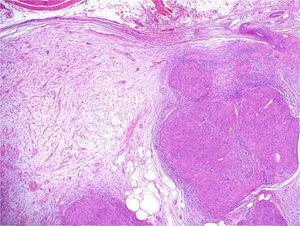 Neural proliferation with hybrid tumor pattern, in which diffuse areas of neurofibroma can be seen, within which classic schwannoma nodules are observed. Staining with hematoxylin-eosin ×100.