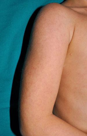 Blau syndrome. Erythematous-brownish papules with a somewhat lichenoid appearance on the arm.