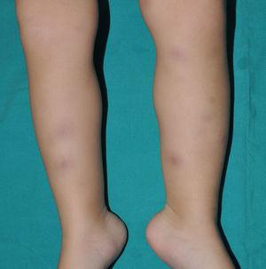 Blau syndrome. Erythematous-violaceous nodules in both pretibial areas, with a very similar appearance to erythema nodosum.