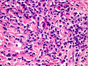 CANDLE (chronic atypical neutrophilic dermatosis with lipodystrophy and elevated temperature) syndrome. Infiltrate of atypical mononuclear myeloid cells with large, mottled nuclei and scant eosinophilic cytoplasm, accompanied by neutrophils and eosinophils (hematoxylin-eosin, original magnification ×40).
