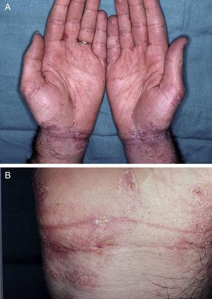 (a) and (b) Eczematous cutaneous lesions induced by oral ivermectin. Same patient as Figure 1.