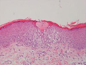 Histological section (haematoxylin and eosin stain) showing a small plasma droplet and epidermal spongiosis characteristic of subacute eczema.