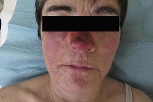 Erythema on the nasal pyramid (imiquimod application site) and cheeks forming confluent plaques with some necrosis in the nasal area.