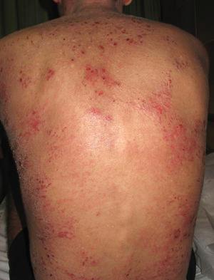 Severe atopic dermatitis. Note the multiple erosions, excoriated papules, and marked xerosis on the back.