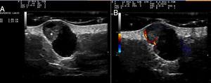 Ultrasound study of the lesion. A,Oval, anechoic, dermal-hypodermal lesion with a triangular hyperechogenic area that protrudes through the wall (asterisk). B,Increased flow at the peripheral level and in the solid triangular portion (Doppler mode).