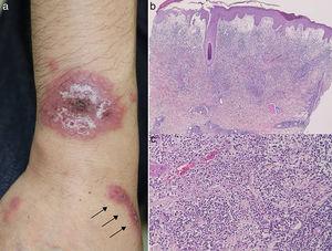 (a) Round, infiltrative erythema with superficial small pustules, and infiltrative linear erythema (arrow) on the forearm. (b, c) Histological features showing prominent edema in the papillary dermis and intense neutrophil infiltration in the upper to mid-dermis. (original magnification; a: ×40, b: ×200).