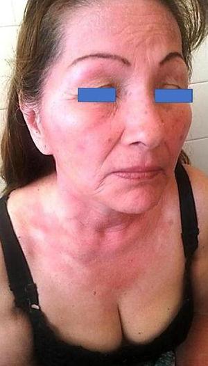 Patient with photosensitized reaction in exposed areas due to use of sunscreen, given her history of basal cell carcinoma. The upper eyelids have been spared; other areas without any reaction are the retroauricular creases and the lower inframaxillary area.
