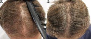 Man aged 28 years with androgenetic alopecia treated with dutasteride 0.5mg/d and minoxidil 5% applied nightly. A, Pretreatment. B, 12 months after start of treatment.