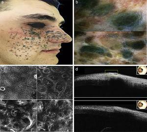 a) Clinical aspect of pigmented lesion b) Dermoscopic features c) RCM in the top left corner: spinous-granular layer of epidermis. In the top right corner: dermo-epidermal junction and upper dermis. In the bottom left corner: upper dermis. In the bottom right corner. Reticular dermis d) OTC images.