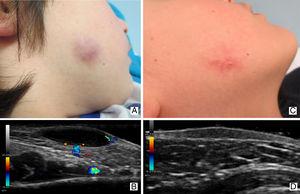 Idiopathic facial aseptic granuloma in a 6-year-old male (Case 1): clinical (A) and ultrasound (B) images of the lesion in the active or inflammatory phase; clinical (C) and ultrasound (D) images of the same lesion 6 months later.