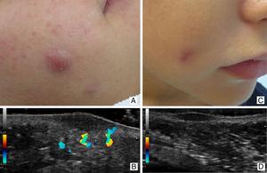 Idiopathic facial aseptic granuloma in a 9-year-old male (Case 2) with associated rosacea skin lesions: clinical (A) and ultrasound (B) images of the lesion in the active or inflammatory phase; clinical (C) and ultrasound (D) images of the lesion in the involutive phase.