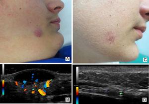 Idiopathic facial aseptic granuloma in a 12-year-old male (Case 3) with associated rosacea skin lesions: clinical (A) and ultrasound (B) images of the lesion in the active or inflammatory phase; clinical (C) and ultrasound (D) images of the same lesion 6 months later.