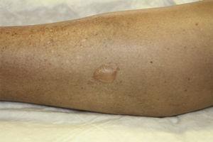 Patient 3: medium-sized blister containing serous fluid on the inner aspect of the right leg.