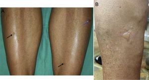 A, Patient 4: small blisters on healthy skin on the anterior aspect of both legs (black arrows) and secondary erosion (blue arrow). B, Patient 1: multiple blisters of various sizes grouped on the lateral aspect of the left leg.