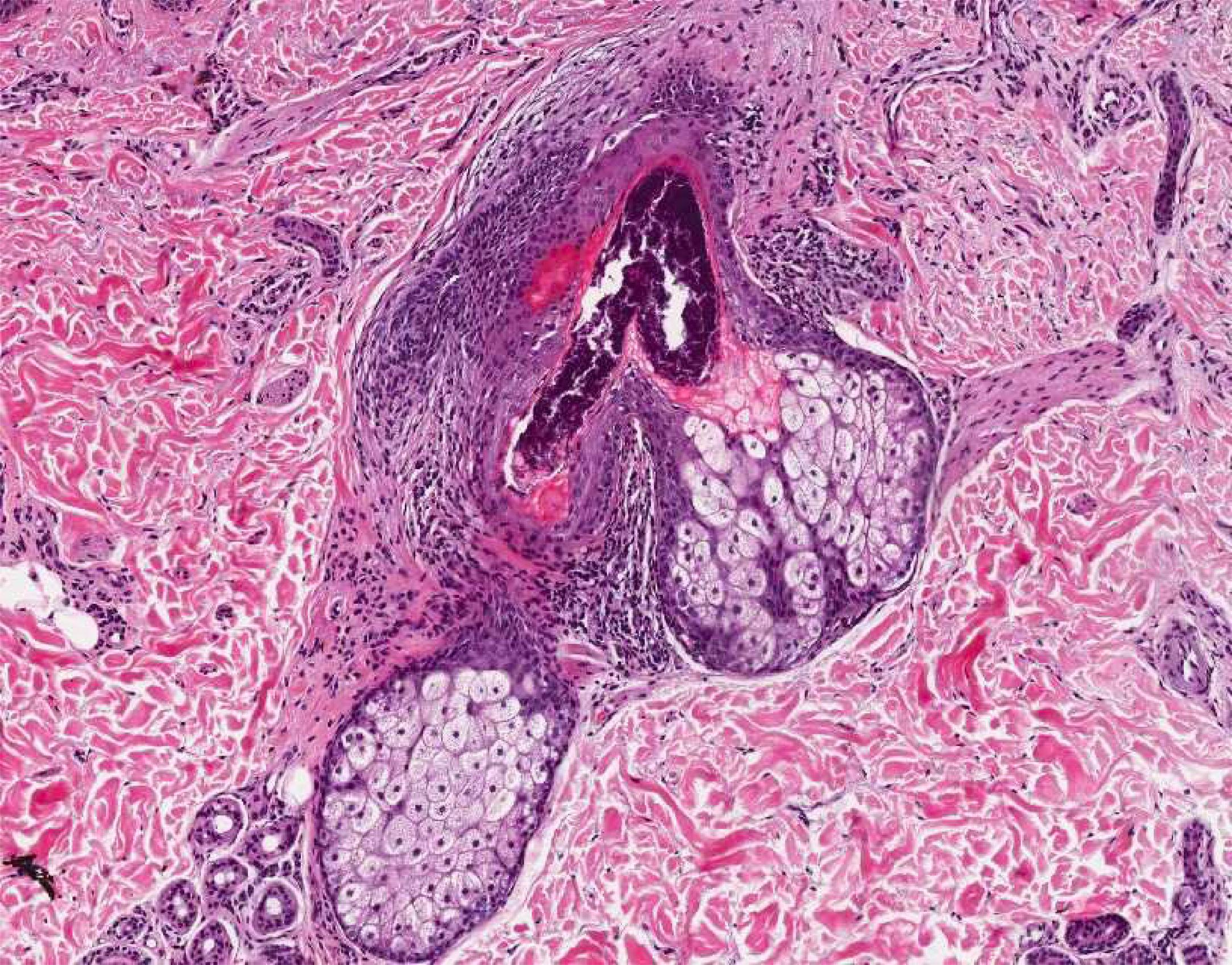 Isotretinoin más barato