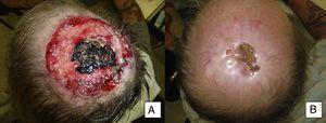 Man aged 50 years with infiltrating basal cell carcinoma measuring 8×8cm on the scalp with exposed bone (A). Treatment with vismodegib led to a response during the first month. The maximum response was observed at 8 months (B). The patient has been disease-free for 13 months (patient 13 in Table 1).