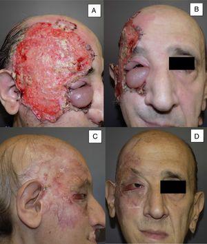 Man aged 53 years with an ulcerated infiltrating basal cell carcinoma measuring 14×10cm on the right temporal area and right orbit with associated palpebral edema and infiltration of lymph nodes (A and B). Clinical signs of a complete response are observed after 8 months of treatment (C and D). Nevertheless, a follow-up biopsy revealed residual tumor, and the response was classified as partial (patient 11 in Table 1).