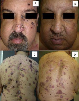 Man aged 51 years affected by Gorlin syndrome with multiple basal cell carcinomas (more than 30) (A and C). A partial response was achieved after 12 months of treatment (B and D) (patient 16 in Table 1).