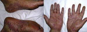 De novo pustular psoriasis with palmoplantar involvement in a patient with hidradenitis suppurativa at 9 months after start of treatment with infliximab.