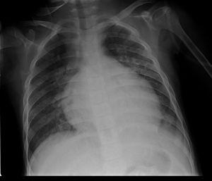 cardiomegaly and findings of acute pulmonary oedema.