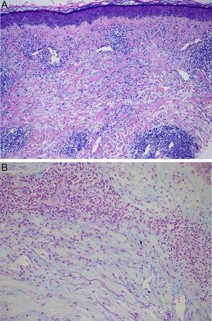 Hematoxylin-eosin, original magnification×40: dense interstitial lymphohistiocytic inflammatory infiltrate (A). Staining with alcian blue×100: mucin deposit between collagen bands and throughout the dermis (B).