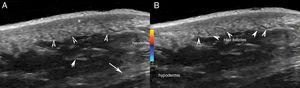 Ultrasound. A, The grey scale (longitudinal axis; right hip) showing thickening and decreased dermal echogenicity (*) with preserved hair follicles (arrow heads). B, Color Doppler (longitudinal axis; right hip) shows absence of dermal or hypodermal hypervascularization. Note the prominent fibrous septa (arrows) in the hypodermis (A and B).