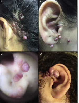 A-D), Clinical presentations in ALHE. Confluent erythematous, sessile papules and nodules, some of which form plaques. A), Case 1; B), Case 2; C), Dermatoscopy of Case 2; and D), Case 3.