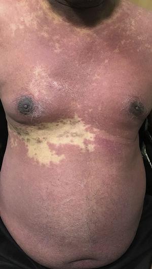Confluent erythematous maculopapular lesions over the chest and abdomen with sparing of the right T9 dermatome.