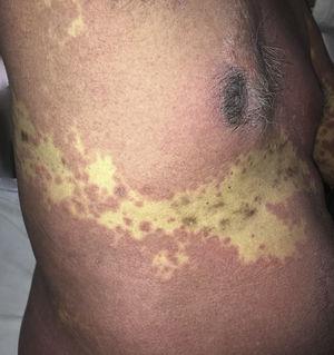 A closer view of the spared site shows hyperpigmentation and scars of healed herpes zoster with sparing of the T9 dermatome by the rash.