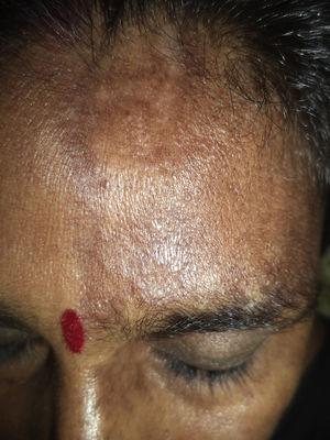 Band of thickened and indurated skin extending vertically along the forehead to the frontal scalp.
