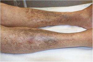 Significant lesion improvement and decreased pigment intensity after suspension of levofloxacin treatment.