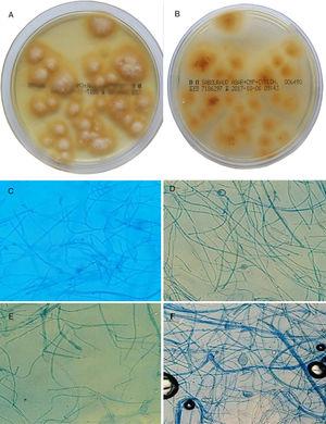 A and B, Culture of hairs and scales in Sabouraud chloramphenicol actidione agar for 15 days at 28°C. Flat colonies with a stellate fringe, a woolly-white superficial mycelium (A), and a pale yellow-orange underside (B) are observed. C–F, Microscopic morphology after incubation for 7 days in potato dextrose agar: C, pectinate hyphae (comb-like structure); D, intercalary chlamydospores (original magnification ×20); E, macroconidium (original magnification ×20); F, terminal chlamydospores of M audouinii (original magnification ×20).