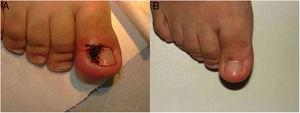 A, Patient with moderate-to-severe ingrown toenail, with considerable erythema, edema and exudation. B, Result after 3 weeks following a single injection of corticosteroids.