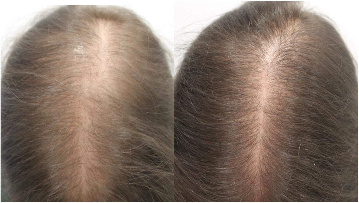 Oral Minoxidil Offers Strong Results Against Alopecia  Consult QD