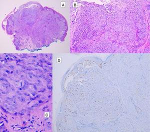 Spitzoid tumor. A, Proliferation of epithelioid melanocytes with a central nodular area that contains atypical melanocytes (B) and frequent mitosis (C). The central nodular area shows increased Ki67 expression (D).