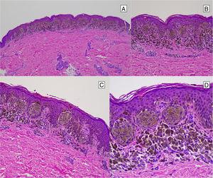Reed nevus. A, Proliferation of spindle-shaped nevus cells without atypia arranged in clumps at the dermal-epidermal junction. B, C, and D, Images showing absence of atypia and abundant intracytoplasmic melanin pigment and dermal melanophages.