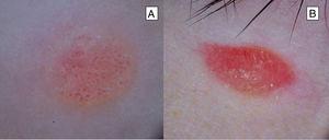Dermatoscopic patterns of classic Spitz nevus. A, Vascular pattern with dotted and monomorphic vessels, distributed regularly over a pink background. B, Homogenous pink vascular pattern showing a pinkish tone in absence of other structures.