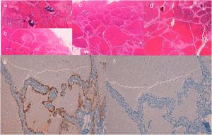 A and B, Case 1. Histology shows focal calcification inside the lesion and intravascular thrombosis (hematoxylin-eosin [HE], original magnification ×40). C, Case 2. Histology shows a well-circumscribed lobed mass composed of multiple, thin-walled, dilated and interconnected vascular channels that form sinusoidal structures (HE, original magnification ×40). D, Case 3. Histology shows dilated, interconnected vascular channels forming a sinusoidal pattern, with no evidence of calcifications or thrombi (HE, original magnification ×40). E, Case 2. Immunohistochemistry for WT1 (original magnification ×200). F, Case 2. Immunohistochemistry for D2-40 (original magnification ×200).