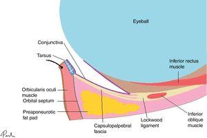 Basic eyelid anatomy. Anterior lamella (skin and orbicularis oculi muscle), medial lamella (orbital septum and orbital fat), and posterior lamella (capsulopalpebral fascia, tarsus, and conjunctiva).