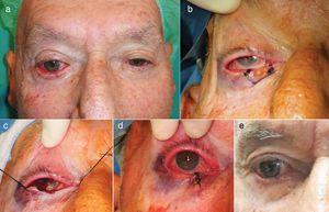 Pentagonal excision. A, Basal cell carcinoma in the lower right eyelid in an 85-year-old male patient with mixed ectropion (involutional and mechanical caused by the tumor). B and C, Pentagonal tumor resection was designed to achieve the oncological objective as well as the reconstructive one, by avoiding ectropion with a reduction in the horizontal component of the eyelid. Outcome of the technique immediately after the procedure (D) and at 8 weeks (E).