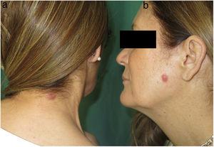 Firm, infiltrated, erythematous cupuliform papules in the posterior cervical region (A) and on the left cheek (B).