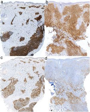 Immunohistochemistry showing positive staining for CD4 (original magnification ×2) in the lesions in the cervical region (A) and on the left cheek (B). Immunohistochemistry showing positive staining for PD-1 (original magnification ×2) in the lesions in the cervical region (C) and on the left cheek (D).