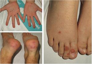 Discrete papular purpuric round-shaped lesions predominantly on plantar surfaces or heels.